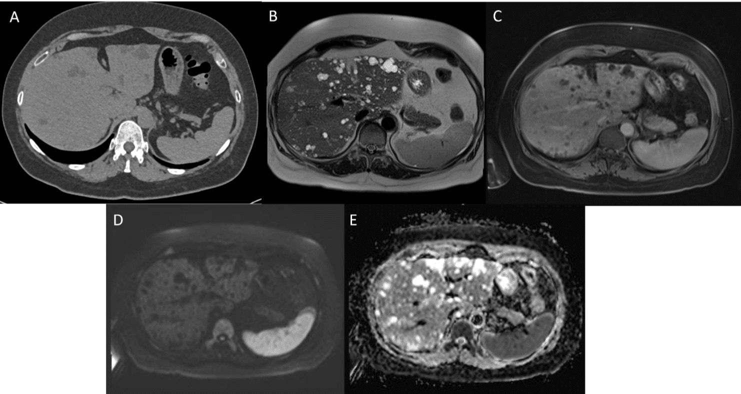 Figure 1. Axial imaging demonstrates numerous small, diffusely distributed hepatic lesions. (A) Non-contrast CT image demonstrating numerous hypoattenuating hepatic lesions. (B) T2-weighted magnetic resonance imaging (MRI) with diffuse, nodular and cystic, homogeneous (without internal septations or mural components) hyperintense hepatic lesions (up to 19 mm) without enhancement on subsequent (C) post-contrast T1-weighted MRI images, which also did not reveal clear communication with the primary biliary tree or biliary ductal dilatation. No restricted diffusion was observed when correlating (D) diffusion-weighted imaging (DWI) with (E) apparent diffusion coefficient (ADC) maps.